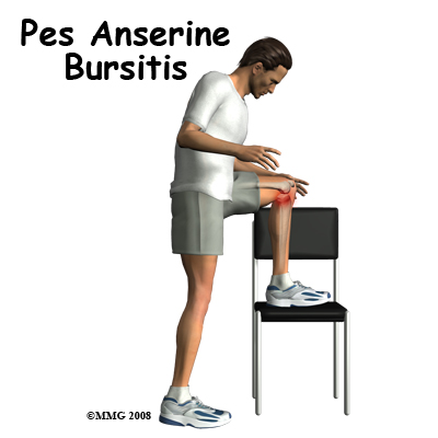 Pes Anserine Bursitis of the Knee
